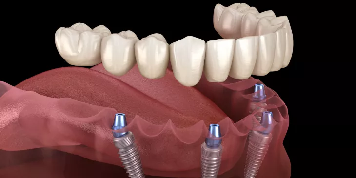 Dental Implant KL