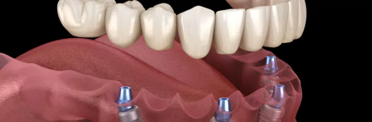 Dental Implant KL